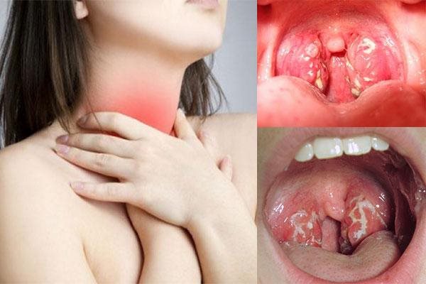 Đối tượng có nguy cơ cao mắc bệnh viêm amydal